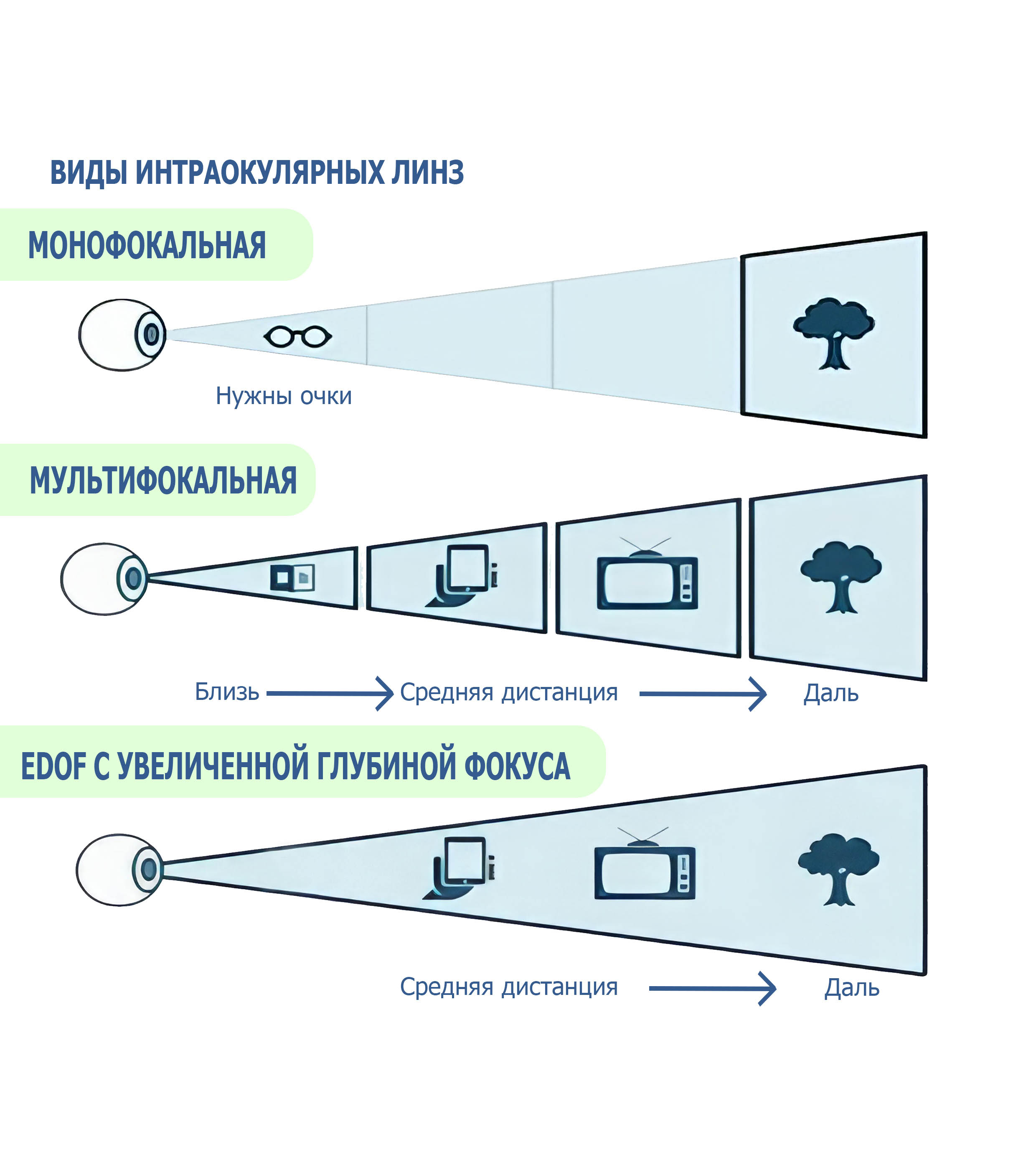 Виды интраокулярных линз